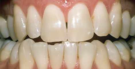 Reálne zuby pred bielením s pásikmi Crest 3D White Professional Effects